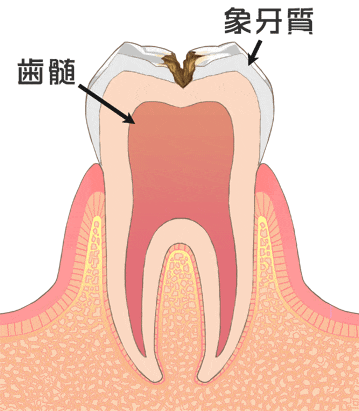 歯の内部まで進行したむし歯