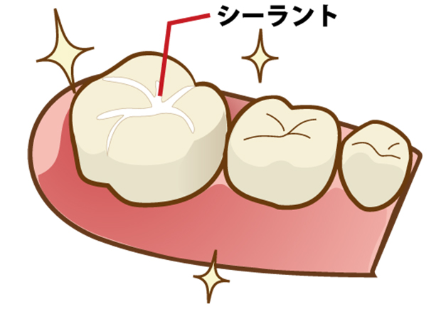 シーラント充填とは