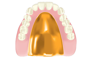 ゴールド床義歯