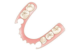 ノンクラスプ義歯