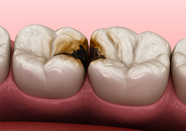 むし歯治療について