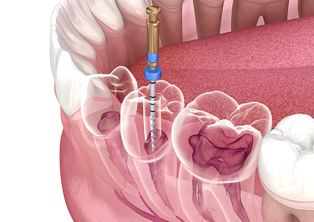 根管治療中および治療後の痛みについて