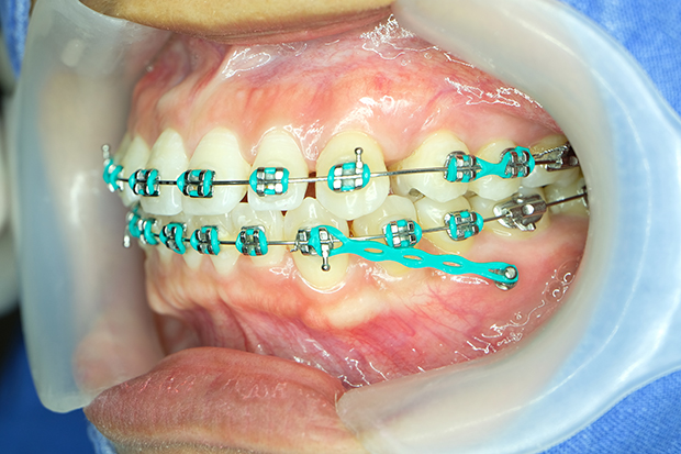 歯科矯正用アンカースクリュー