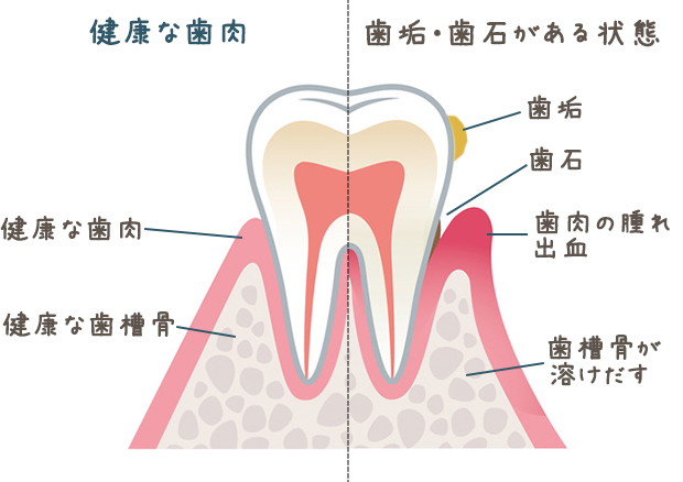 歯垢と歯石