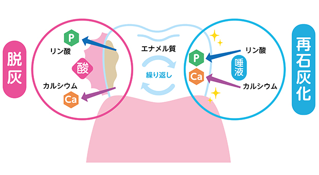 むし歯の成り立ち